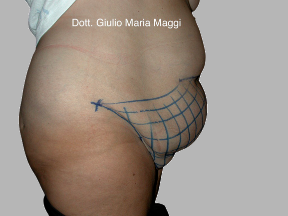addominoplastica prima e dopo