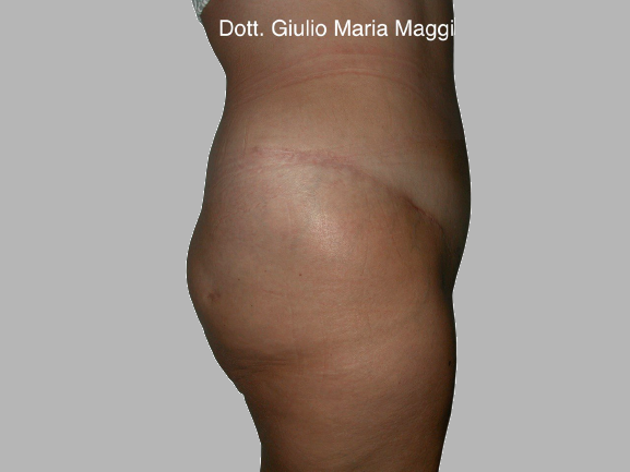addominoplastica prima e dopo