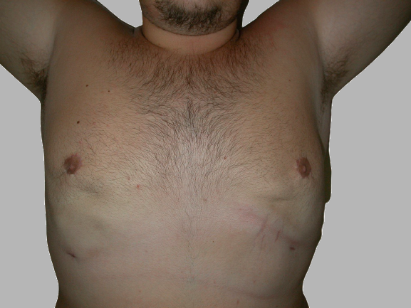 ginecomastia prima e dopo