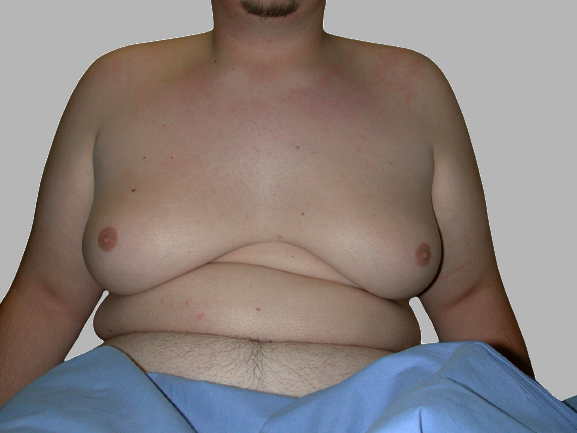 ginecomastia maschile