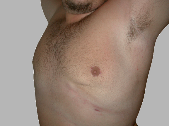 ginecomastia prima e dopo