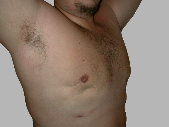 ginecomastia prima e dopo