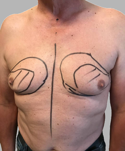 ginecomastia prima e dopo