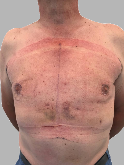 ginecomastia prima e dopo