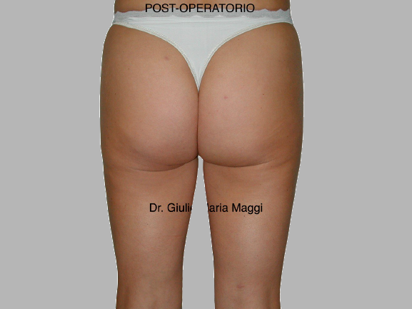 liposcultura prima e dopo