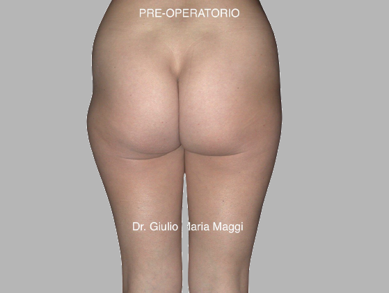liposuzione prima e dopo