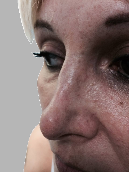 rinoplastica prima e dopo