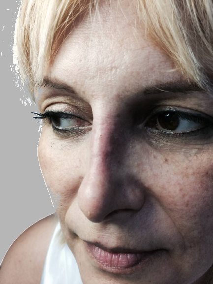 rinoplastica prima e dopo