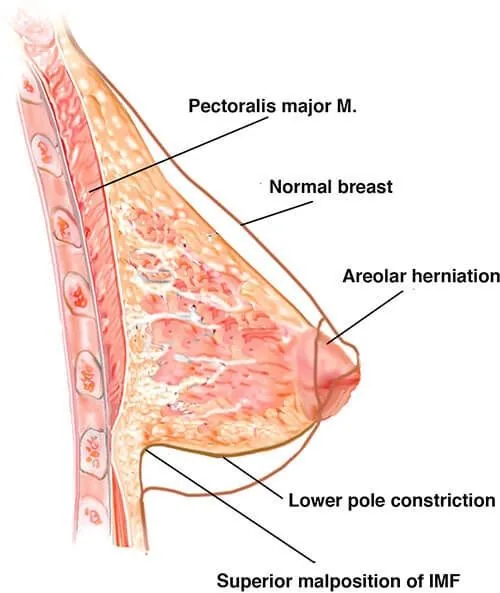 Tuberous Breasts Treatment NYC