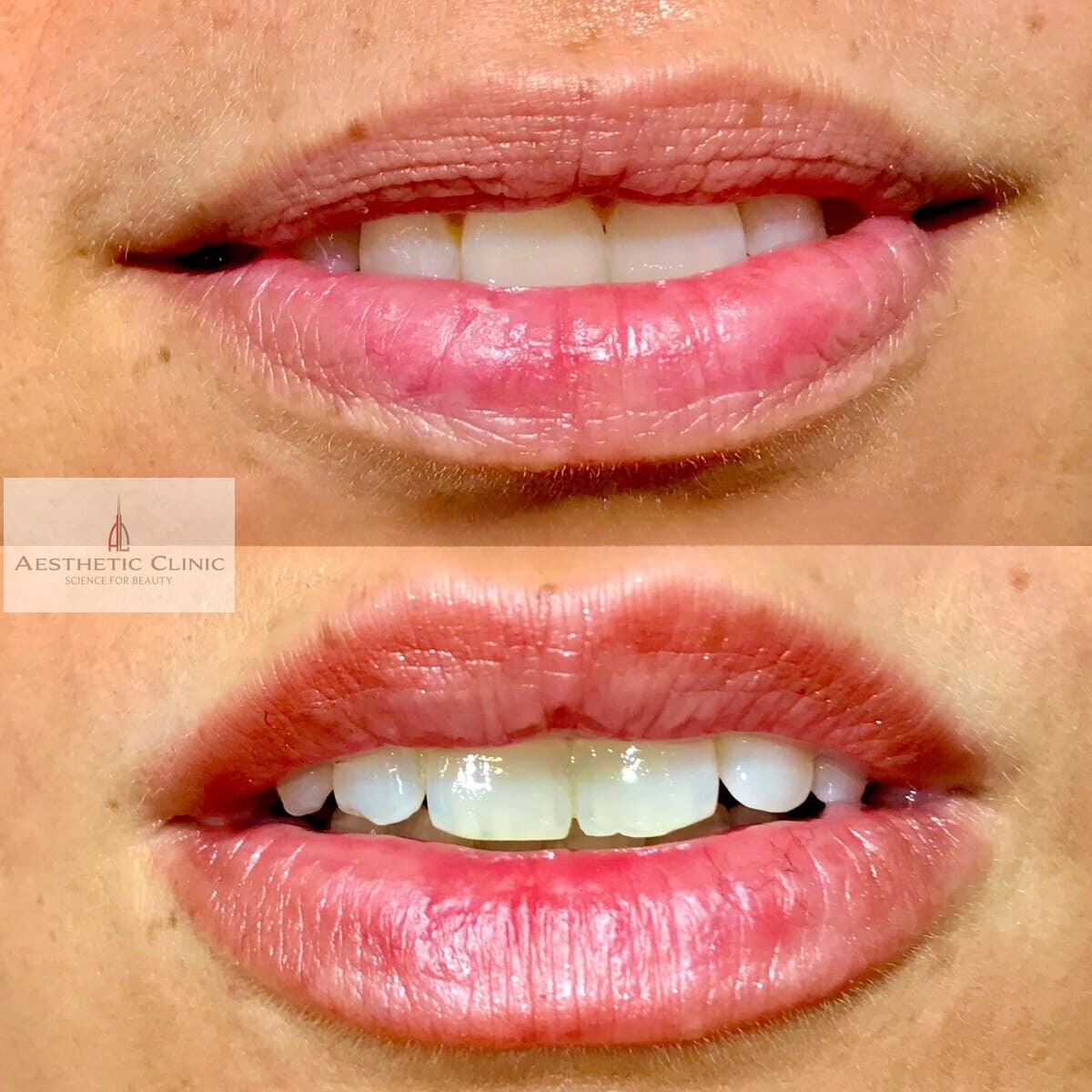 prima e dopo filler labbra naturale eseguito dal Dott. Giulio Maggi a Torino