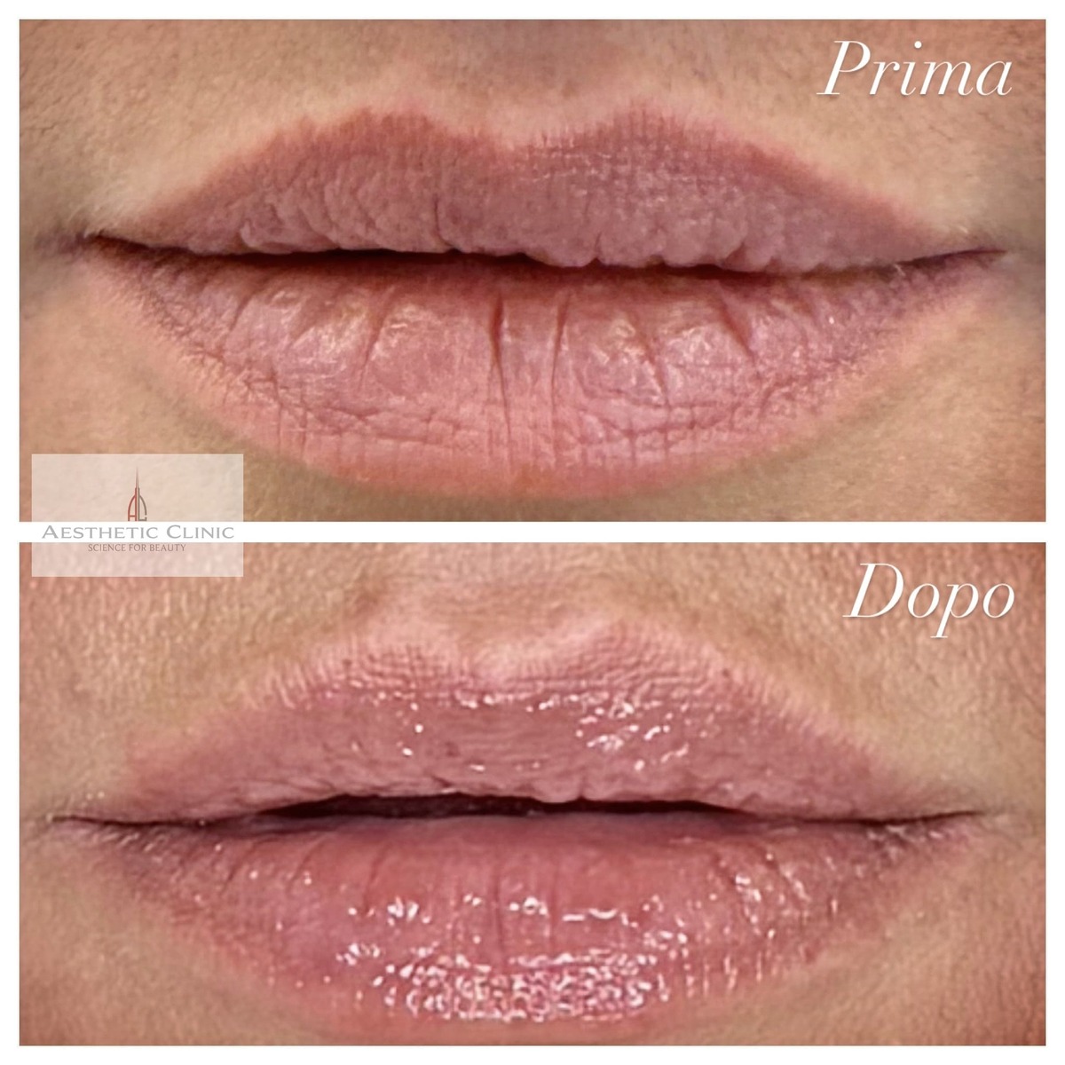 prima e dopo filler labbra naturale miglioramento idratazione e definizione eseguito dal dott giulio maggi torino