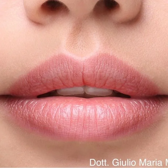 Filler labbra per rimodellare le labbra in maniera naturale