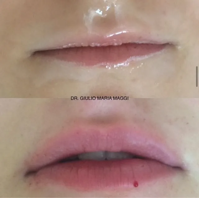 filler labbra risultati