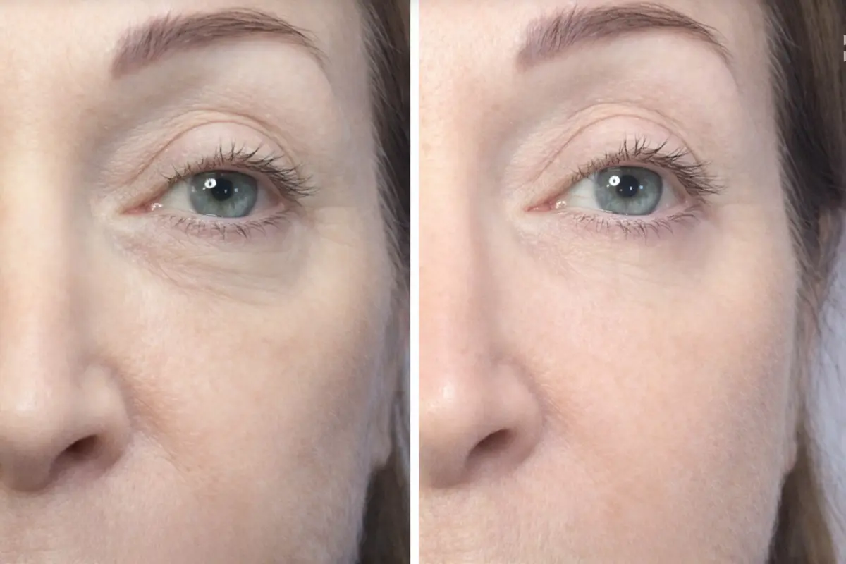 filler occhiaie prima e dopo risultato naturale correzione solco lacrimale