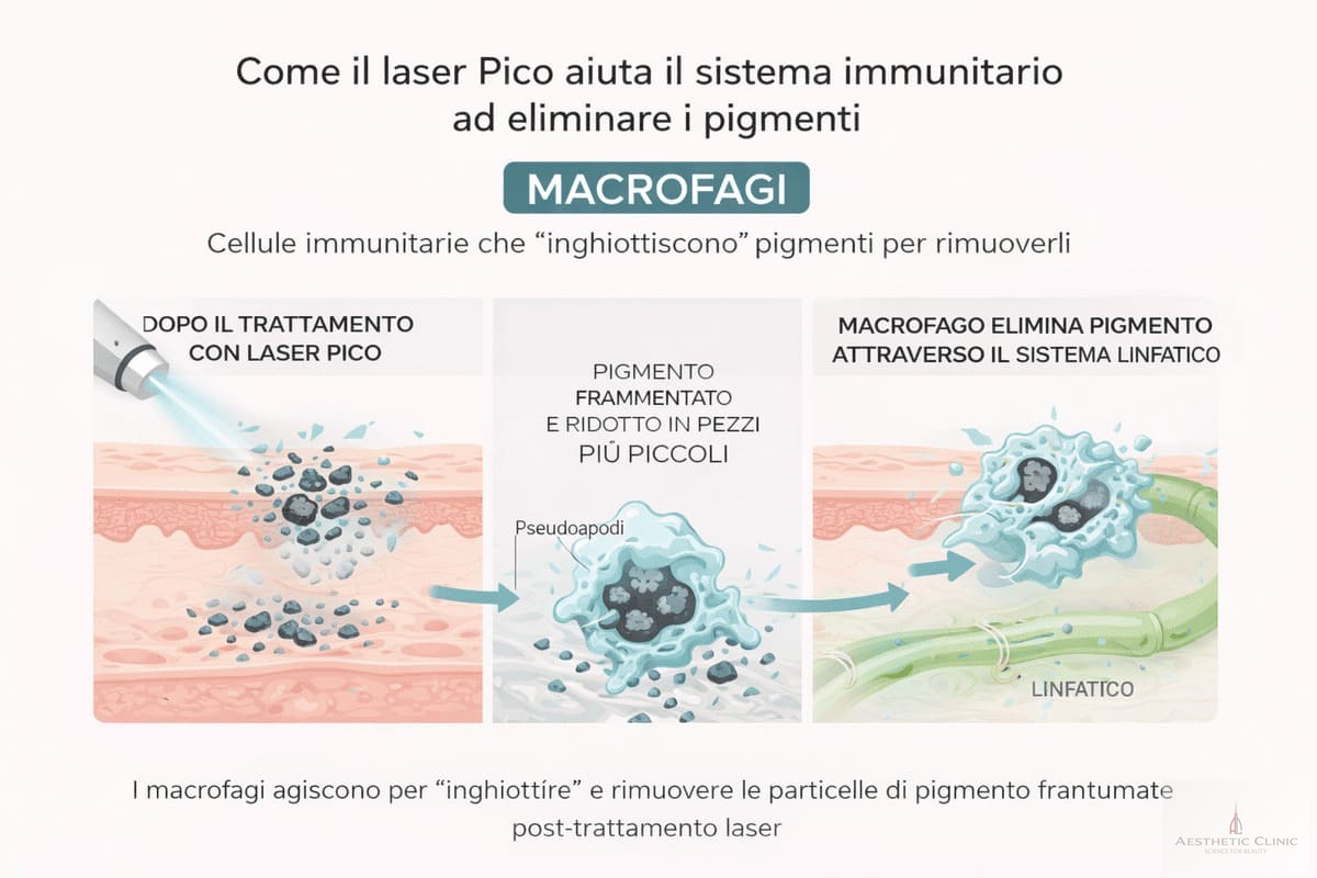 Macrofagi eliminano pigmento dopo trattamento laser Pico attraverso sistema linfatico