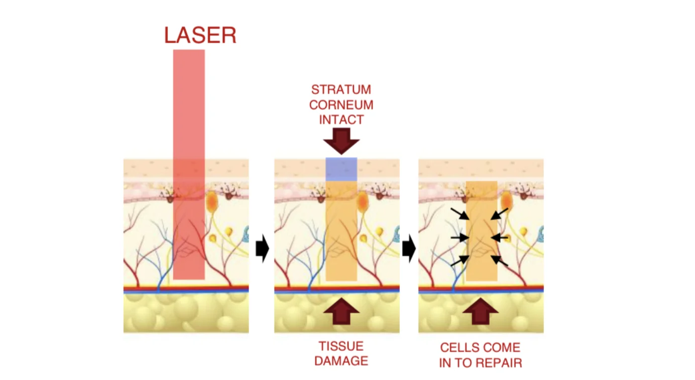 Come funziona il laser frazionato non ablativo LaserMe