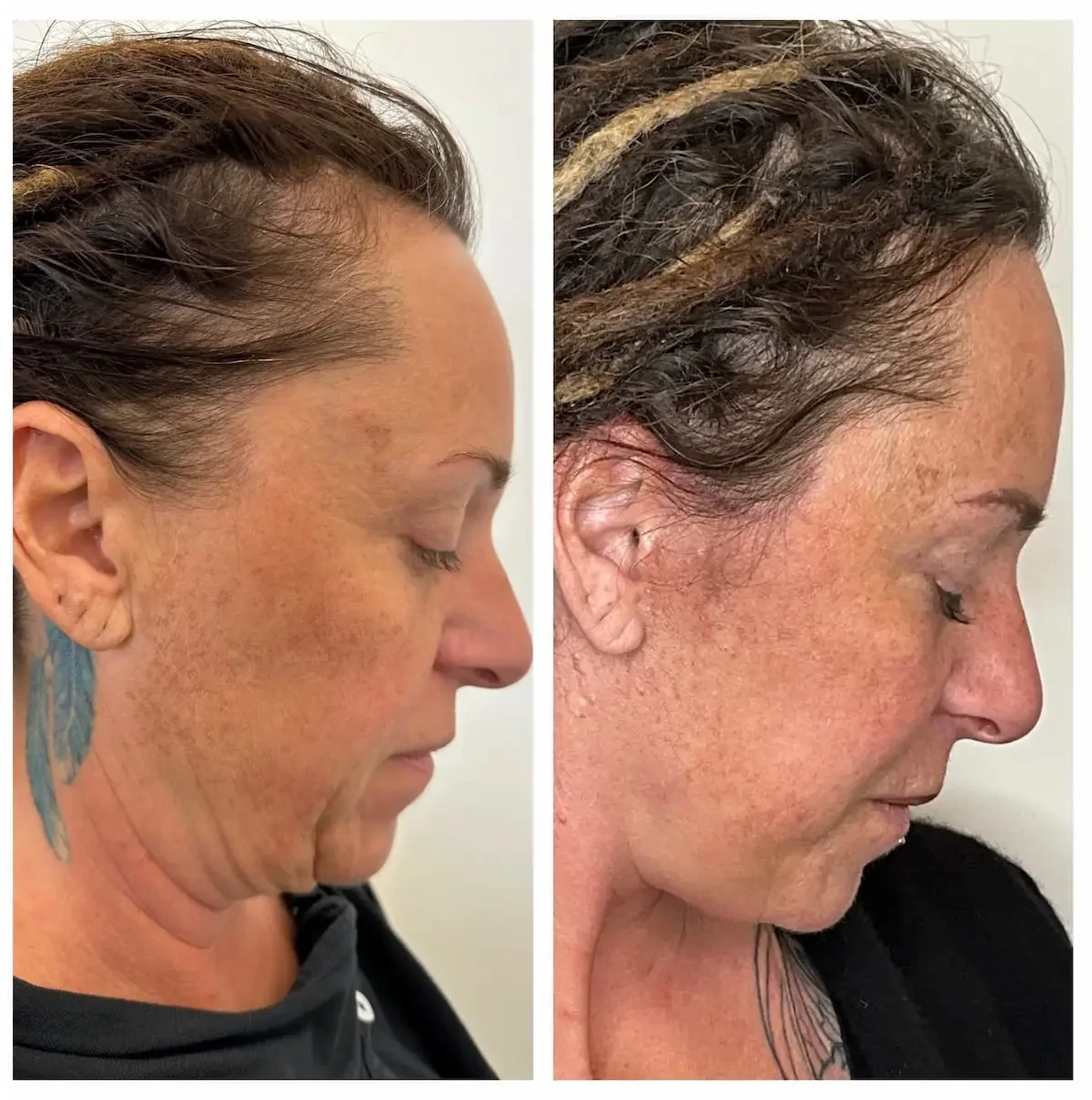 Lifting collo Deep Plane prima e dopo con miglioramento dell’angolo cervico-mentoniero e definizione mandibolare