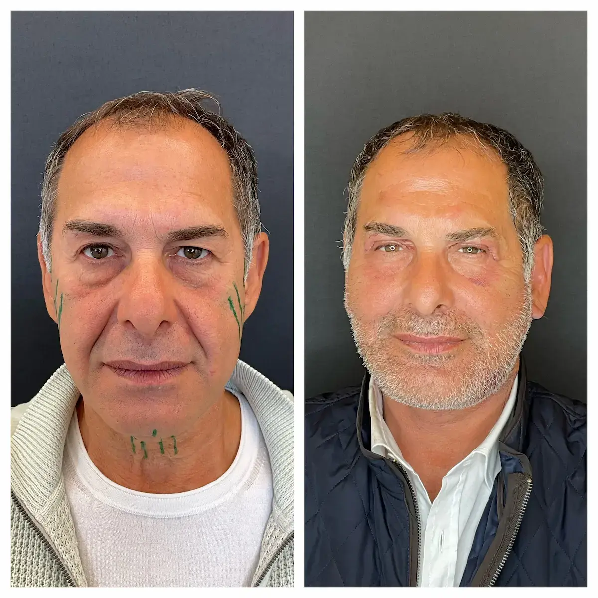 Lifting Deep Plane uomo prima e dopo con ridefinizione della jawline e ringiovanimento naturale del volto