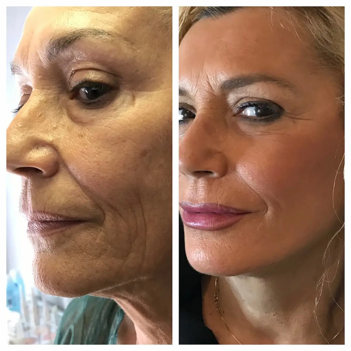 Lifting Deep Plane prima e dopo in paziente donna con ripristino del terzo medio del volto