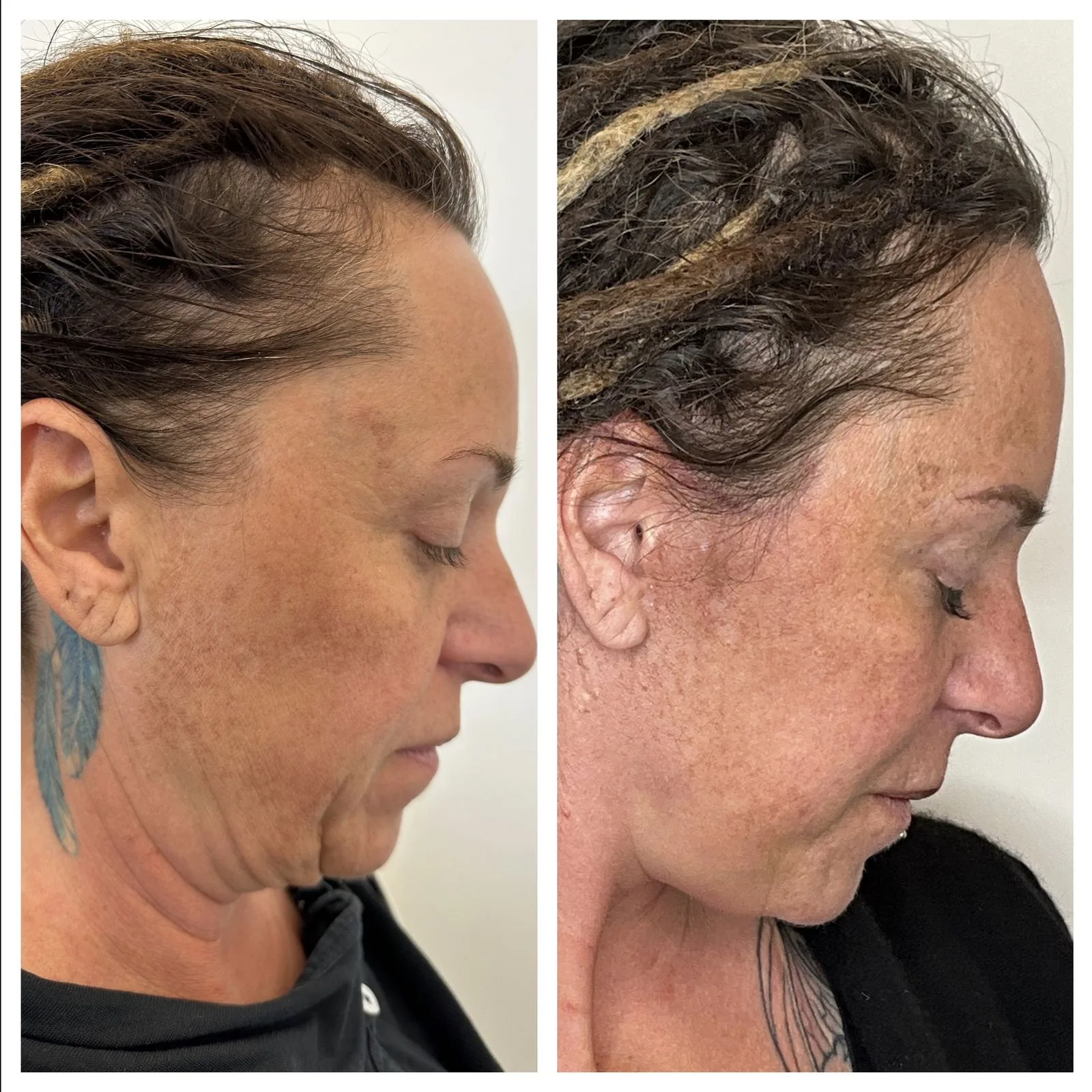 lifting viso o facciale prima e dopo donna 40 anni di profilo