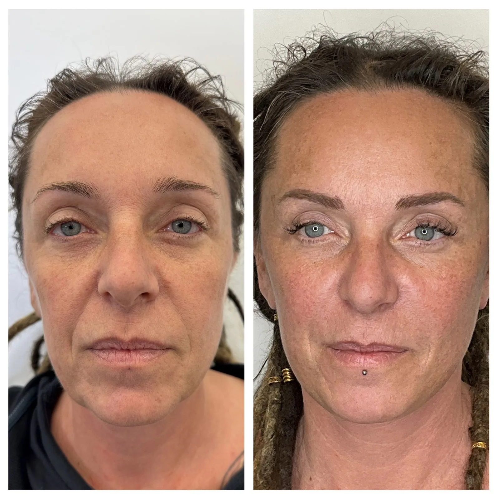 lifting viso o facciale prima e dopo donna 40 anni