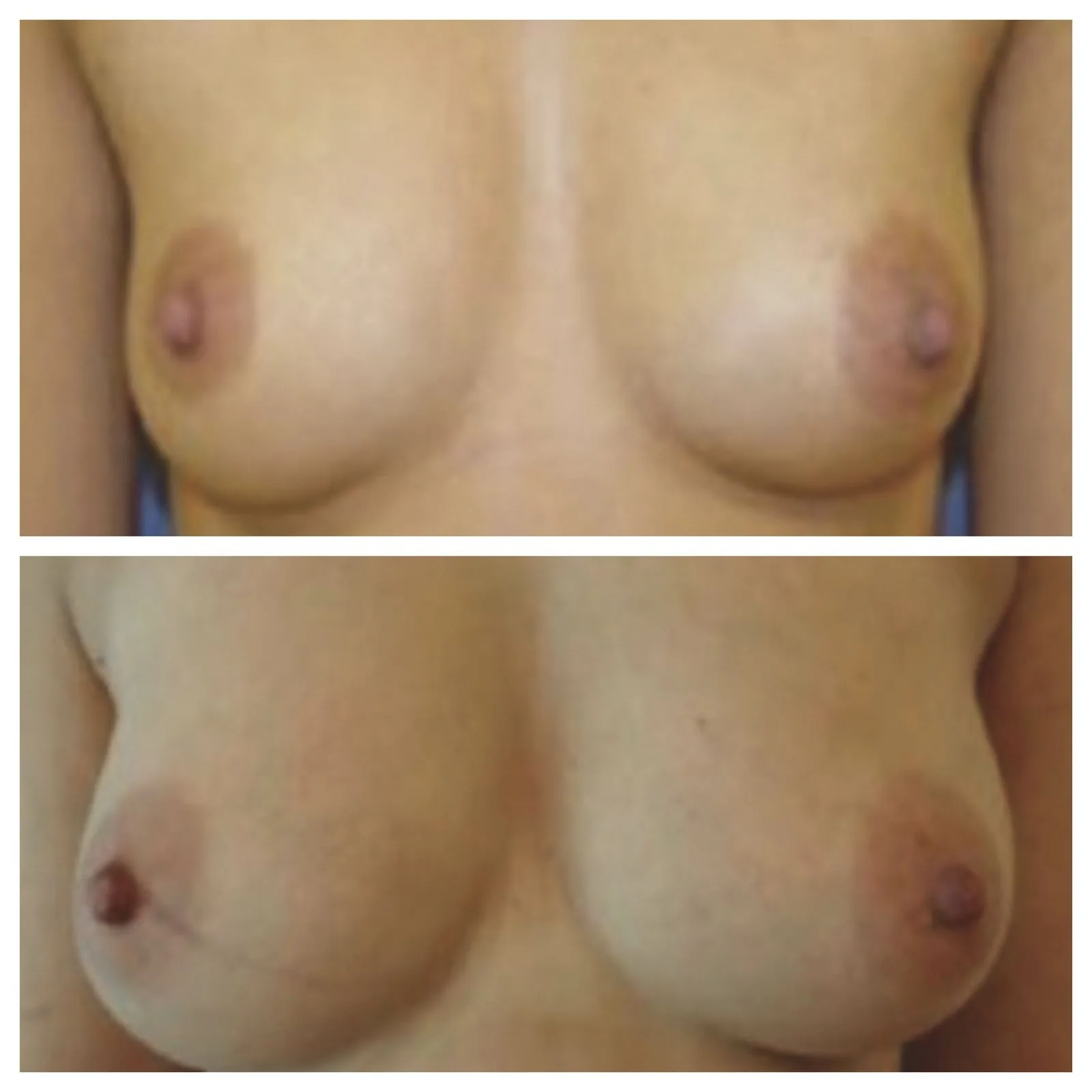 lipofilling seno prima e dopo
