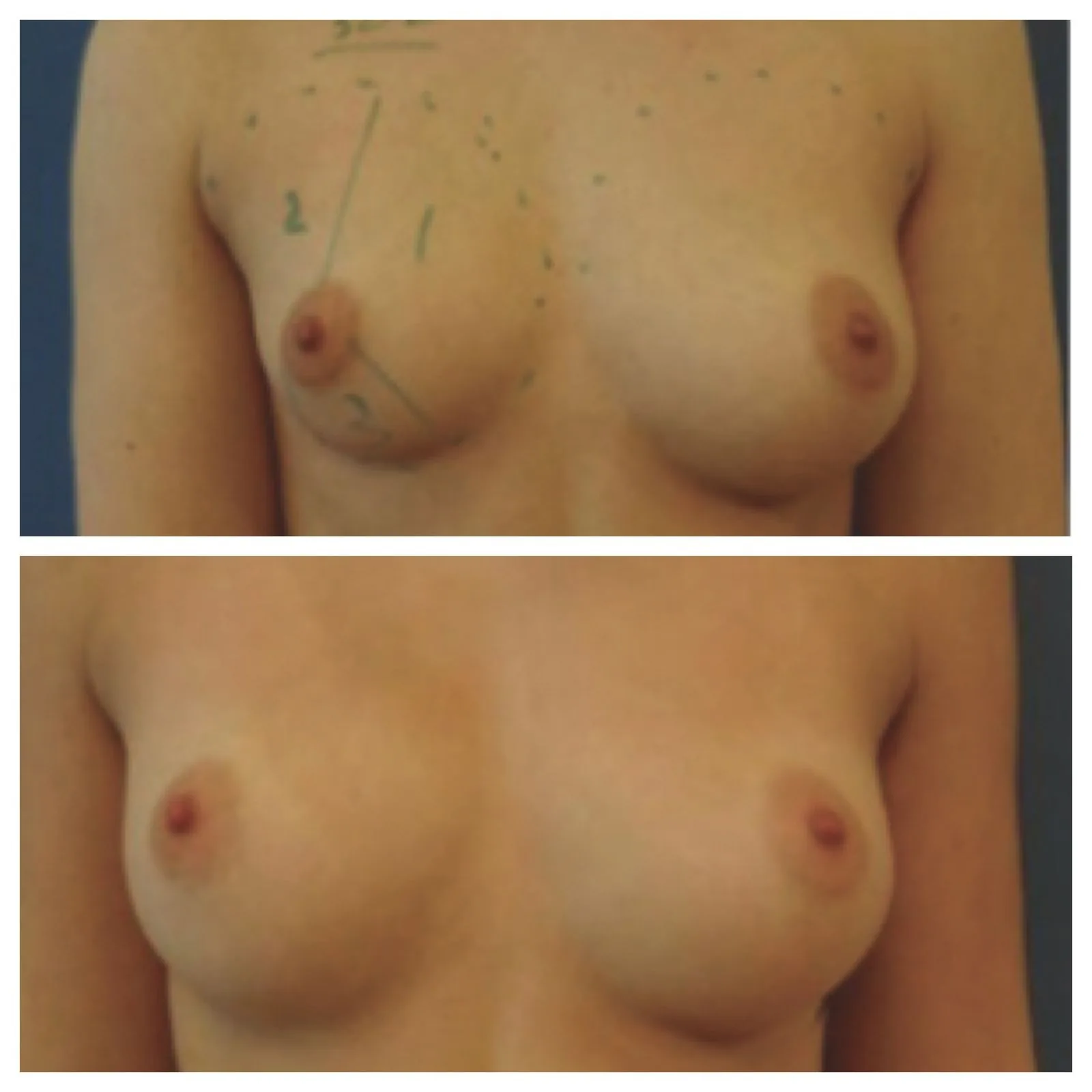 lipofilling seno prima e dopo