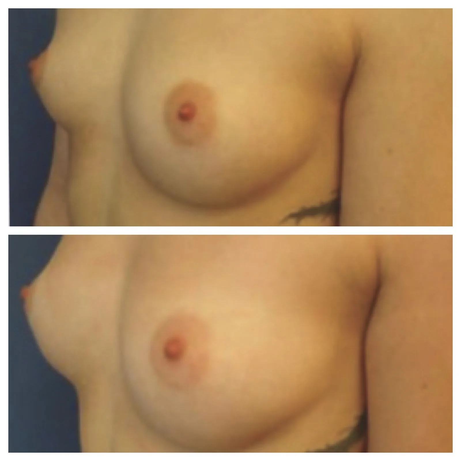 lipofilling seno prima e dopo