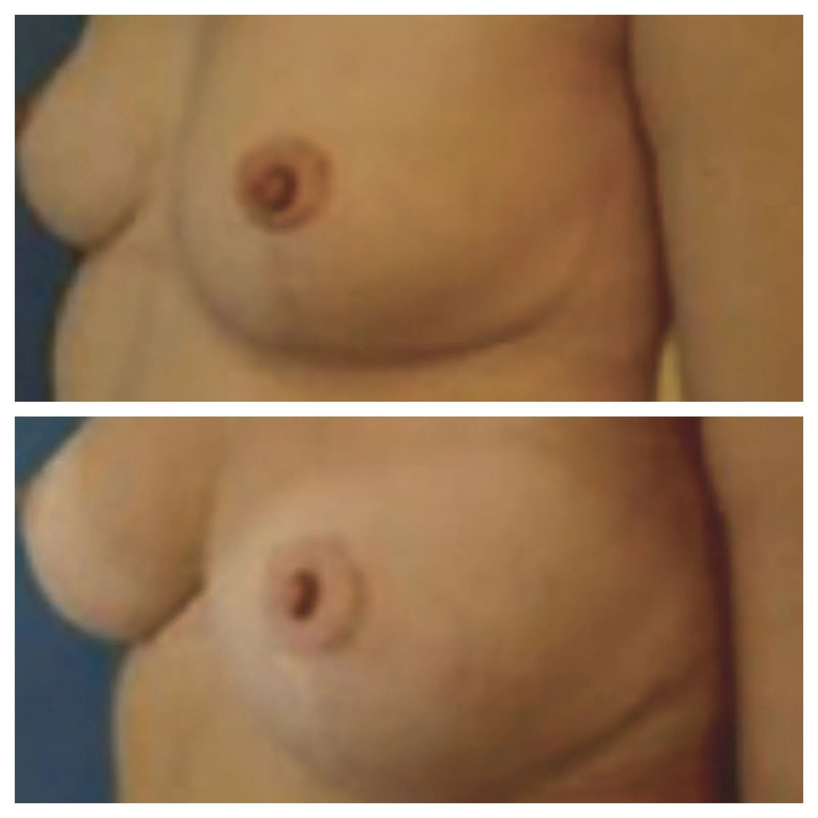 lipofilling seno prima e dopo