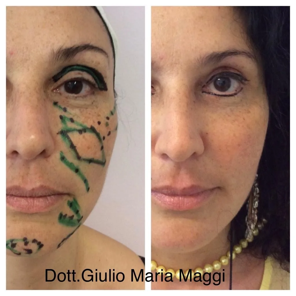 lipofilling viso prima e dopo