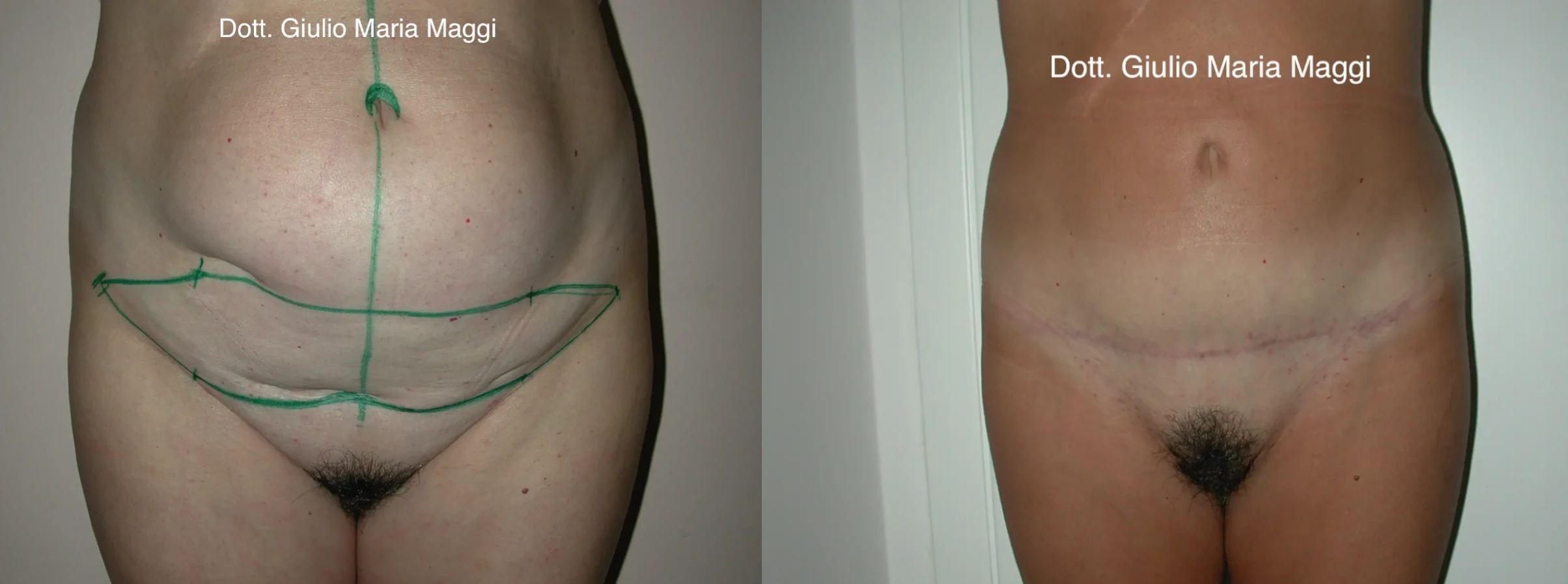 Risultato di lipoaddominoplastica frontale: eliminazione della lassità cutanea e correzione dell'addome pendulo, intervento eseguito dal Dott. Giulio Maria Maggi.