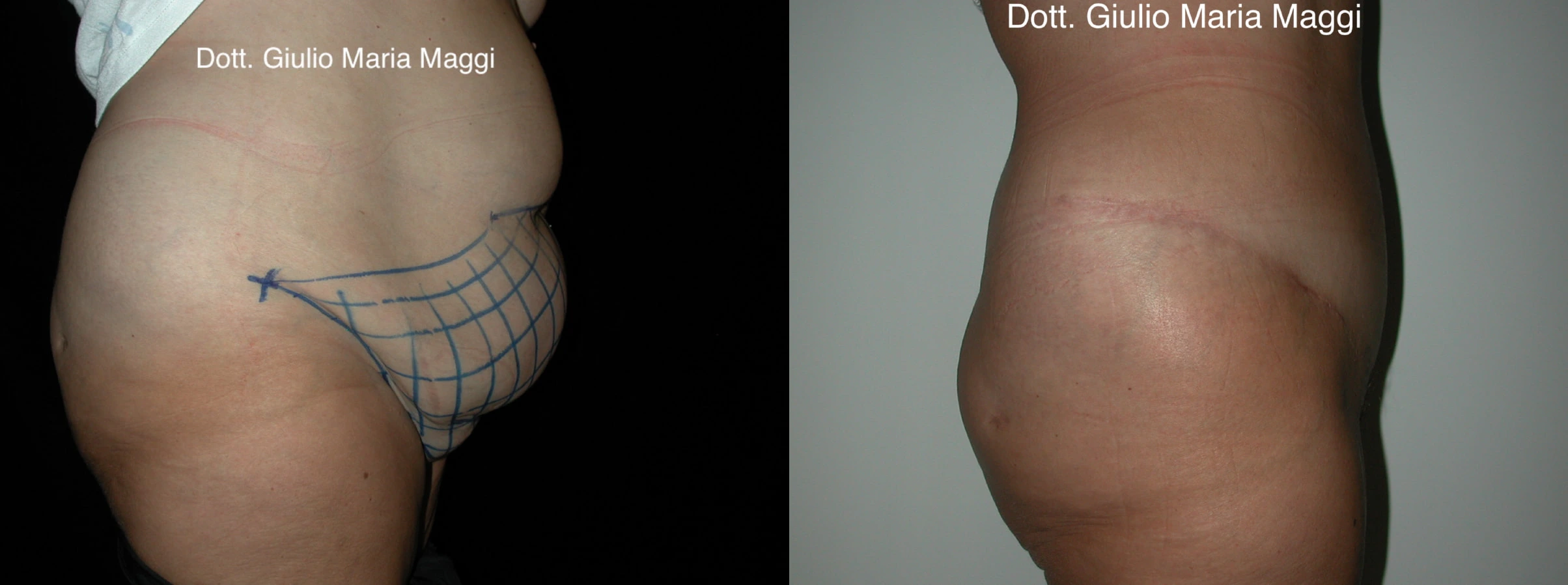 Risultato di lipoaddominoplastica frontale: eliminazione della lassità cutanea e correzione dell'addome pendulo, intervento eseguito dal Dott. Giulio Maria Maggi