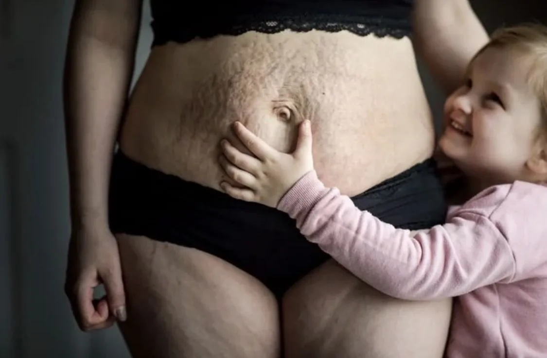 Mommy Makeover, quando è davvero il momento giusto per farlo