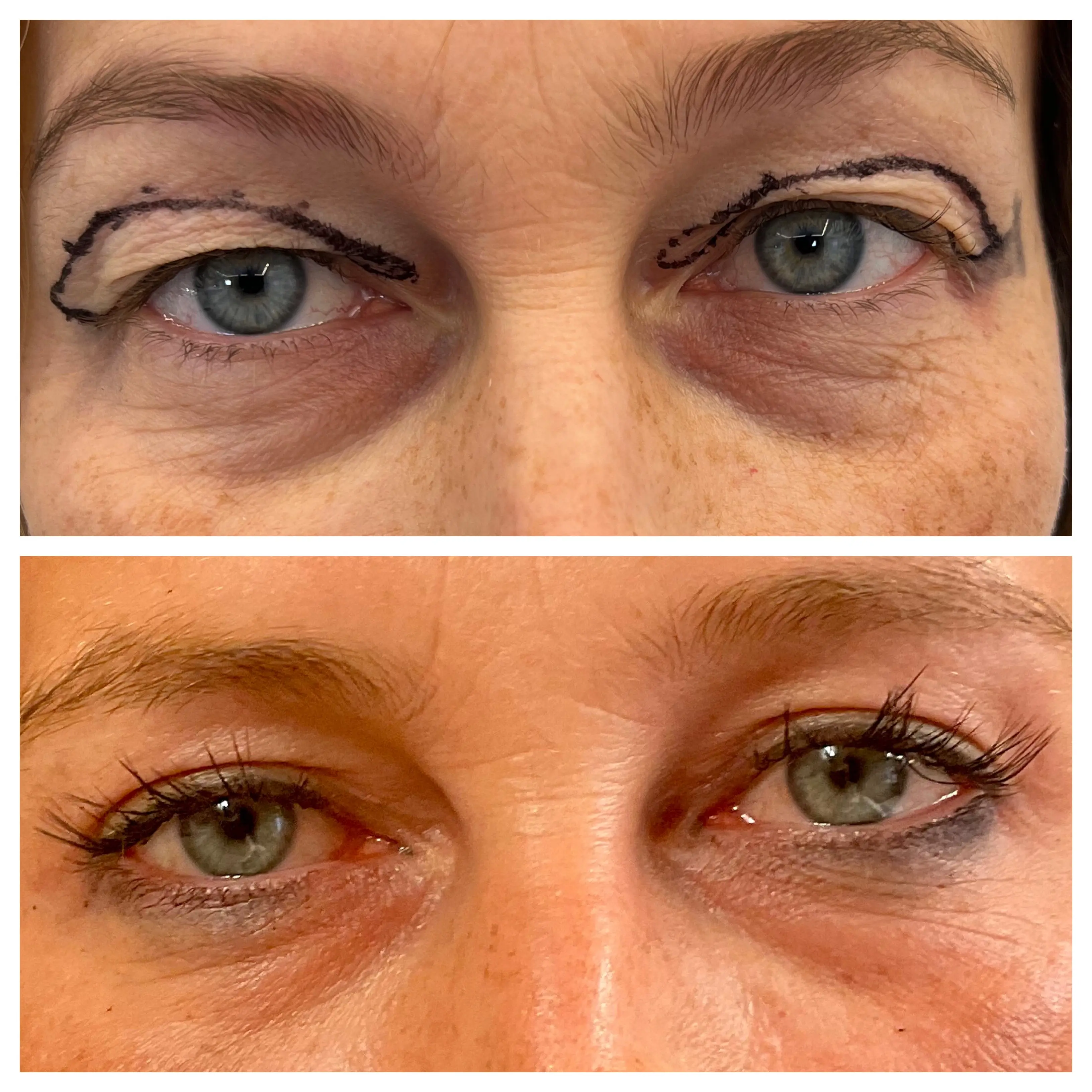 Blefaroplastica superiore eseguita con approccio conservativo con risultato naturale dello sguardo