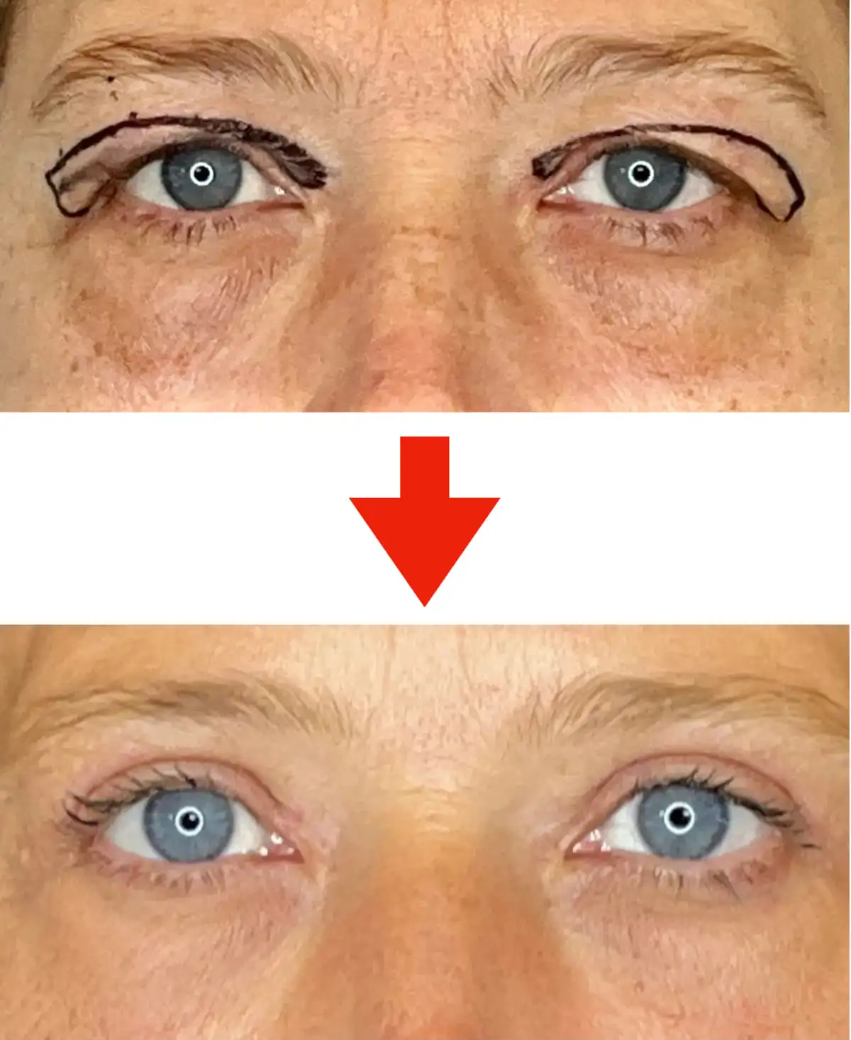 Palpebra cadente prima e dopo blefaroplastica con miglioramento dello sguardo