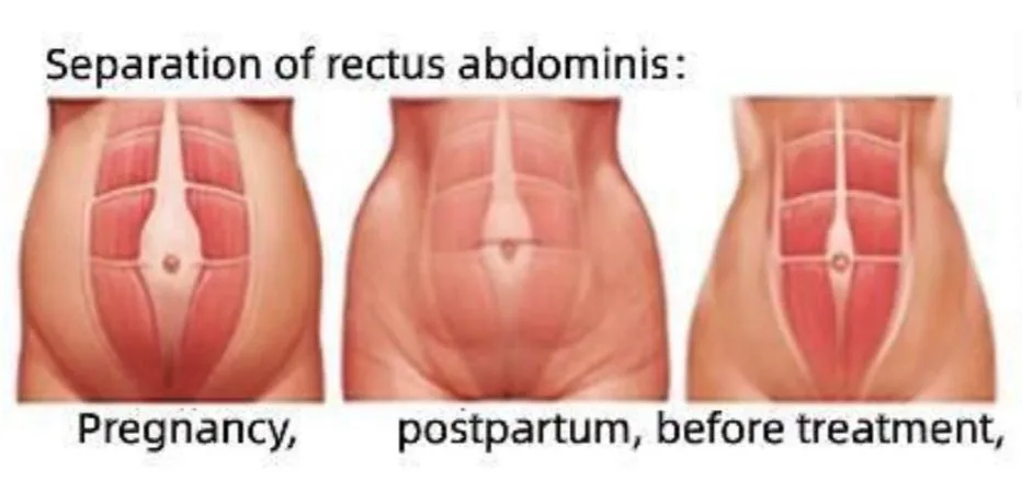 riabilitazione pavimento pelvico
